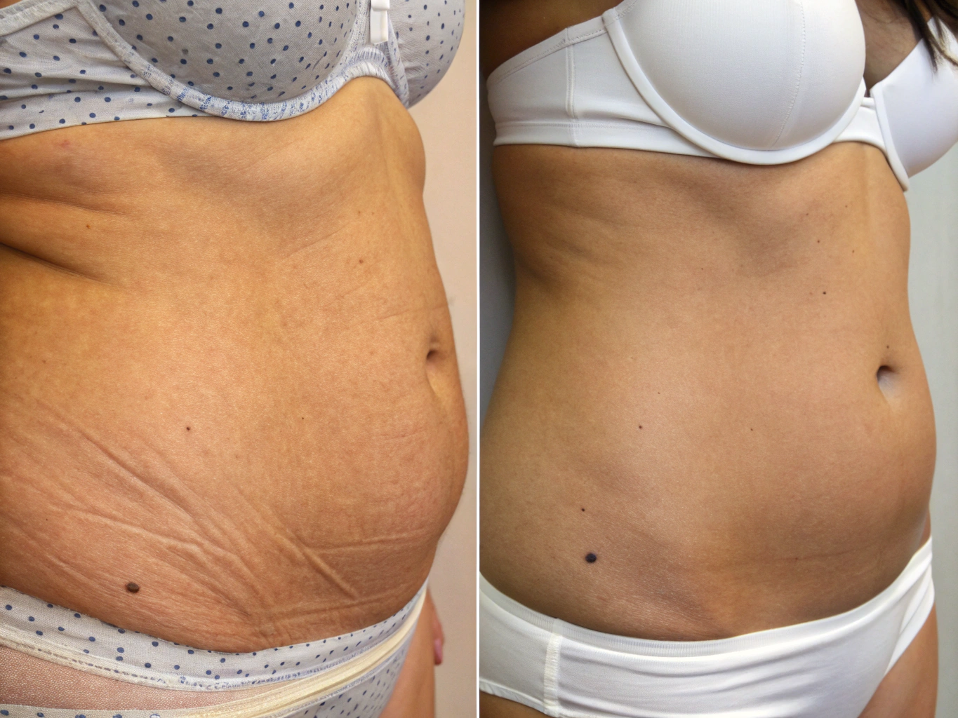 Lipoescultura S-Curve resultado final